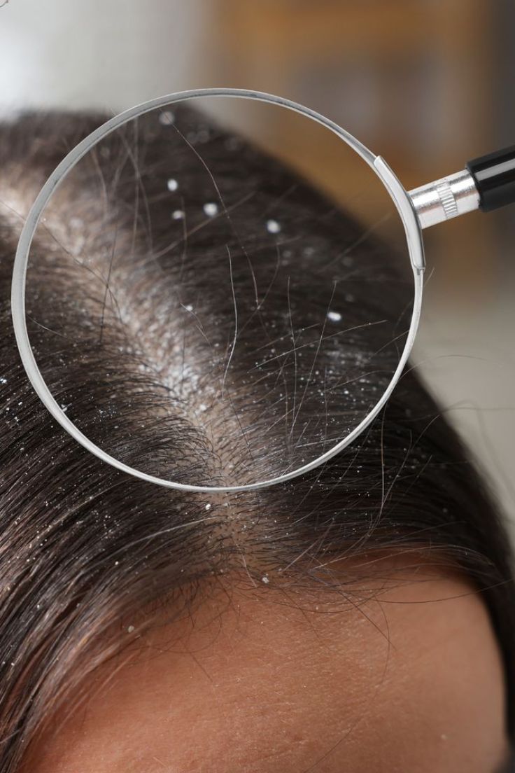 Anti-dandruff