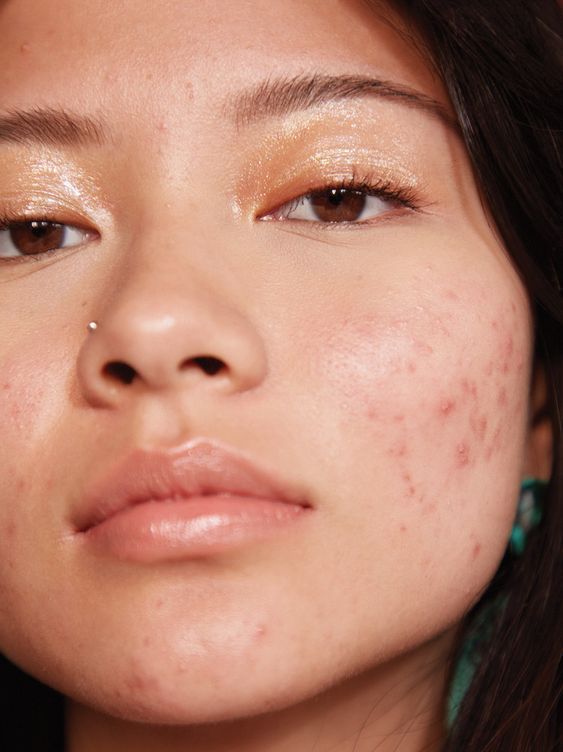 Acne-Blemish